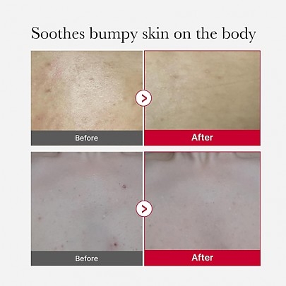 [MEDICUBE] Кислотный пилинг для тела Red Acne Body Peeling Shot 2.0 110гр